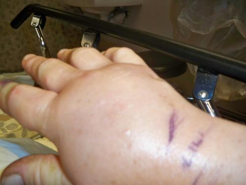 swollen hand after copperhead bite