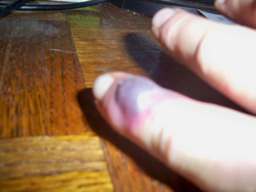 the bite on my finger