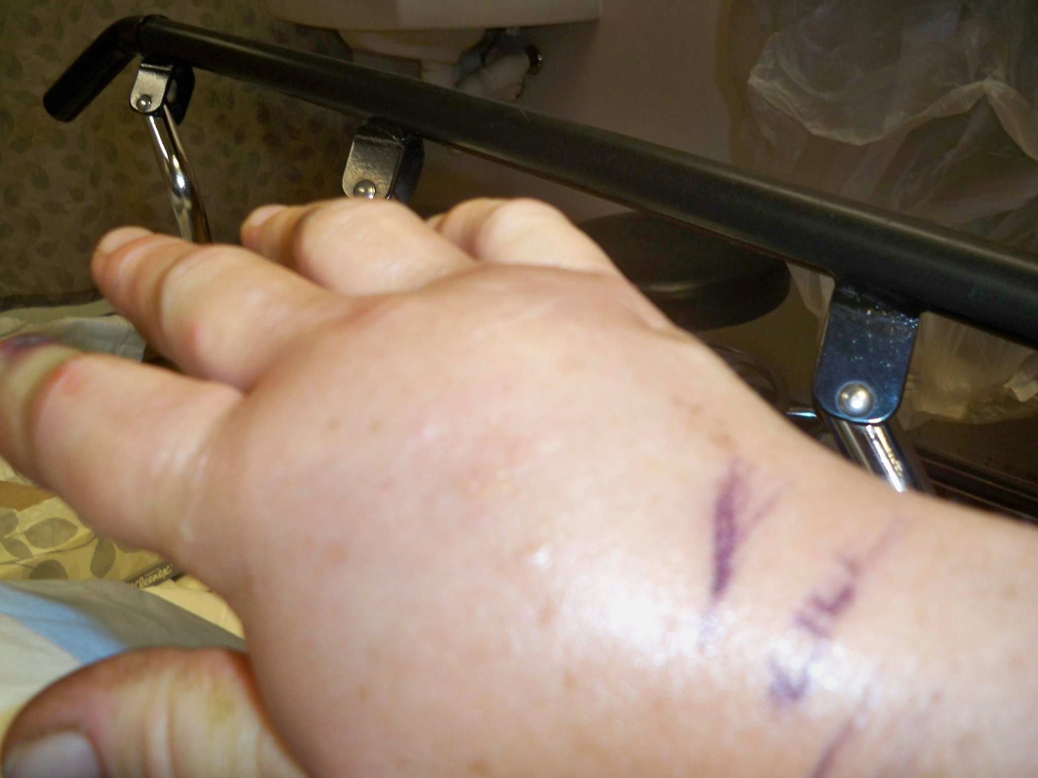 Ann's copperhead bite 1.JPG