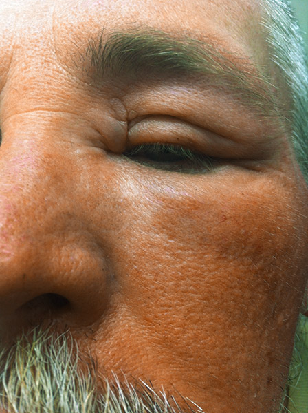BeeSting_2-onEyelid_052318.jpg